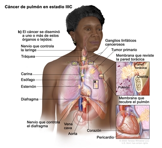 Cáncer de pulmón en estadio IIIC. En la imagen se observan un tumor primario en el pulmón izquierdo y a) tumores separados en el mismo lóbulo del pulmón que el tumor primario. También se observa b) cáncer que se diseminó a los siguientes sitios: la pared torácica y la membrana que reviste el interior de la pared torácica, el nervio que controla la laringe, la tráquea, la carina, el esófago, el esternón, el diafragma, el nervio que controla el diafragma, el corazón, la aorta, la vena cava, el pericardio (membrana que rodea el corazón).