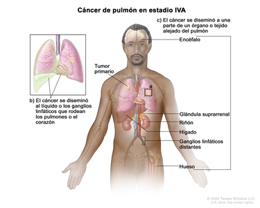 Cáncer de pulmón en estadio IVA. En la imagen se observa un tumor primario en el pulmón derecho y un tumor en el pulmón izquierdo (a). En un recuadro se muestran líquido y ganglios linfáticos cancerosos alrededor de los pulmones y el corazón (b). También se muestran otros órganos o tejidos donde a veces se disemina el cáncer de pulmón, como el encéfalo, la glándula suprarrenal, el riñón, el hígado y los ganglios linfáticos distantes (c).