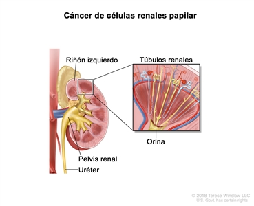 Cáncer de células renales papilar. En la imagen se observan el riñón izquierdo, la pelvis renal y el uréter. En una ampliación, también se muestran los túbulos renales que producen la orina.