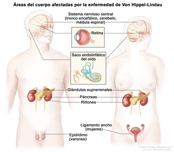 En la imagen se observan las siluetas del cuerpo de un hombre y de una mujer en las que se muestran las áreas del cuerpo afectadas por la enfermedad de Von Hippel-Lindau. Estas áreas son el sistema nervioso central (incluso el tronco encefálico, el cerebelo y la médula espinal), la retina, el saco endolinfático del oído, las glándulas suprarrenales, el páncreas, los riñones, el epidídimo (en varones) y el ligamento ancho (en mujeres).