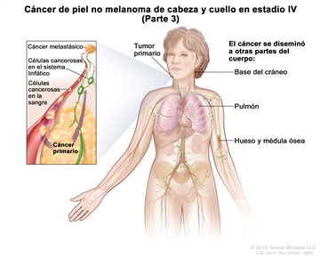 Cáncer de piel no melanoma de cabeza y cuello en estadio IV (Parte 3). En la imagen se observa un tumor primario en la cara y otras partes del cuerpo donde es posible que el cáncer de piel no melanoma se disemine, como la base del cráneo, el pulmón, el hueso y la médula ósea. En el recuadro se muestran las células cancerosas que se diseminan a través de la sangre y el sistema linfático a otra parte del cuerpo donde se formó el cáncer metastásico.