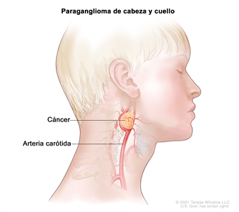 Paraganglioma de cabeza y cuello. En la imagen se observa un tumor canceroso cerca de la arteria carótida en la cabeza y el cuello.