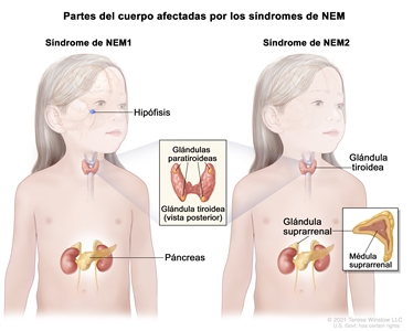 Partes del cuerpo afectadas por los síndromes de neoplasia endocrina múltiple (NEM); la imagen de la izquierda muestra las partes del cuerpo afectadas por el síndrome de NEM1, incluso la hipófisis, las glándulas paratiroideas y el páncreas. En un recuadro se muestra la vista posterior de la glándula tiroidea y las cuatro glándulas paratiroideas del tamaño de una arveja. La imagen de la derecha muestra las partes del cuerpo afectadas por el síndrome de NEM2, incluso la glándula tiroidea, las glándulas paratiroideas y las glándulas suprarrenales. En otro recuadro se muestra la médula suprarrenal (parte interna) de la glándula suprarrenal.