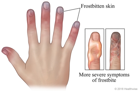 Hand with frostbitten fingers, and detail of fingers with blisters or black skin