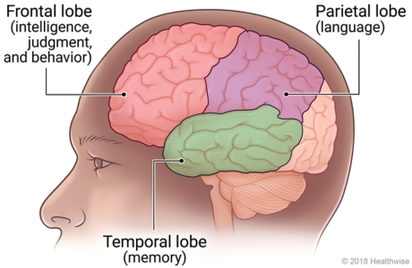 Areas of brain affected by Alzheimer's and other dementias, including the frontal lobe, parietal lobe, and temporal lobe