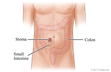 Colon and small intestine, with small intestine attached to stoma