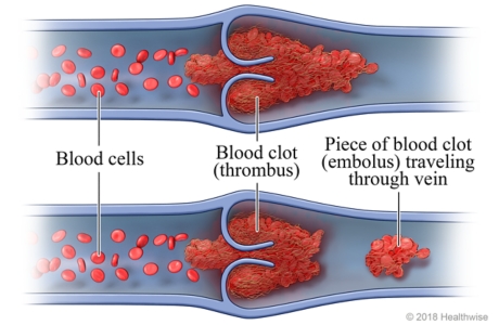 kelainan dan gangguan pada pembuluh darah