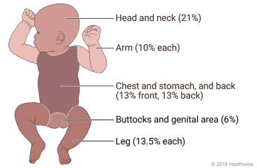 Baby with areas of body marked to show percentages of surface area