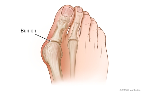 A bunion and the joint at the base of the big toe.