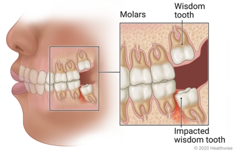 wisdom teeth coming in horizontally