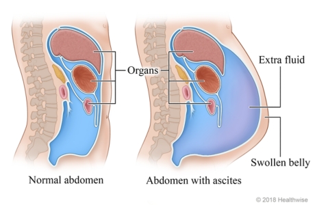 Cross-section of organs in abdomen, showing normal abdomen and abdomen with extra fluid (ascites)