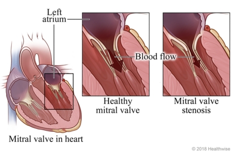 Location of mitral valve in heart, with detail of healthy mitral valve and one with stenosis