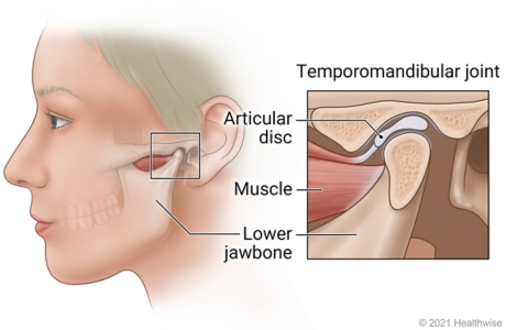 Temporomandibular joint just in front of ear, with detail of joint showing lower jawbone, muscle, and articular disc.