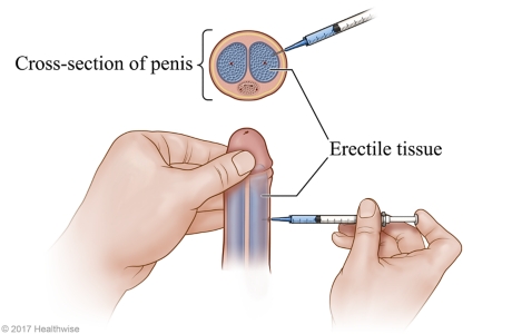Injecting medicine into the side of the penis at a 90-degree angle