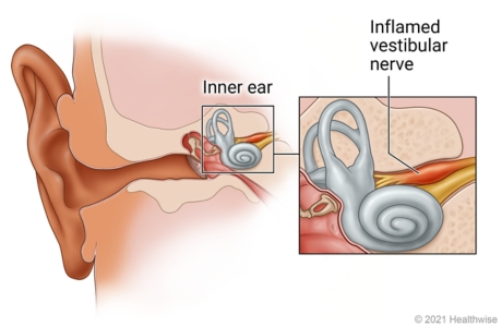 Inner ear, with detail of inflamed vestibular nerve.