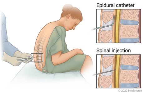 Needle inserted near spinal cord in seated person's back, with details of spinal injection site and epidural catheter placement.