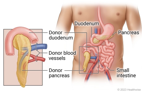 Abdominal organs including duodenum, pancreas, and small intestine, and showing transplant of donor duodenum, pancreas, and blood vessels into lower belly and connected to small intestine.
