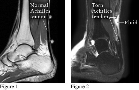 Normal Achilles tendon and torn Achilles tendon