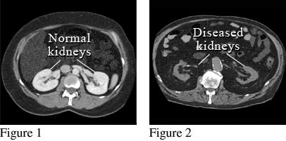 CT Scan of Damaged Kidneys Video & Image
