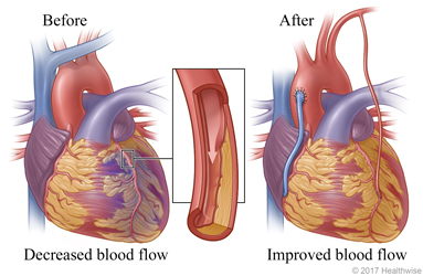 Decreased blood flow caused by narrowed or blocked artery before surgery and improved blood flow after surgery