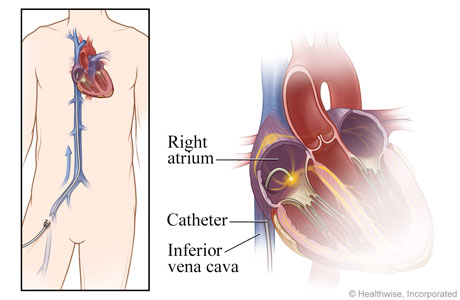 View of catheter from groin to heart, with detail of catheter in the atrium.