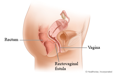 rectovaginal fistula symptoms