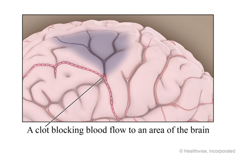 A clot blocking blood flow to an area of the brain.