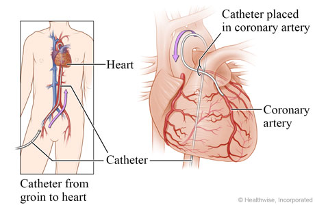 Catheter going from groin to heart, with detail of catheter in a coronary artery