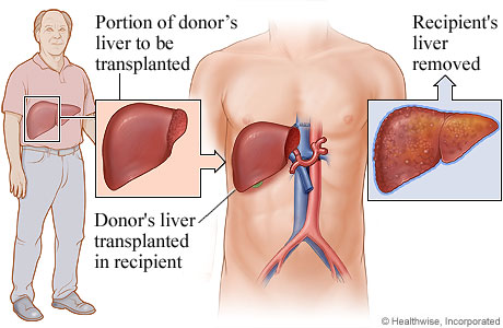 Living Donor Liver Transplant Cigna   H9991470 005 