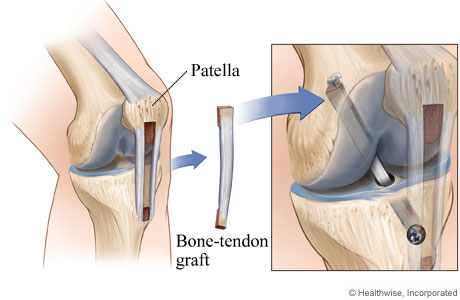 Picture of a bone and knee tissue graft for ACL surgery