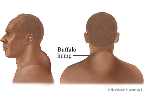 buffalo hump before and after