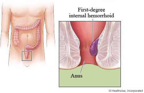Picture of a first-degree internal hemorrhoid