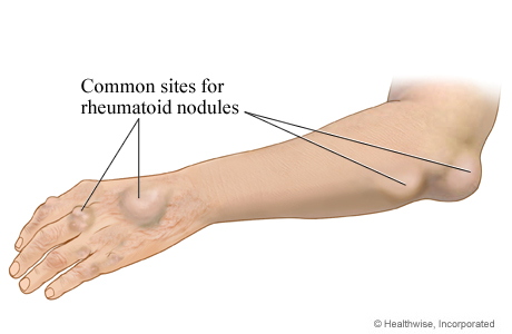 Picture of rheumatoid nodules