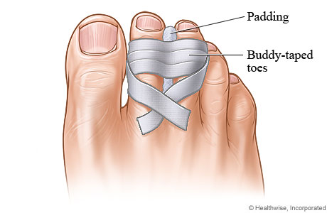 Broken toe buddy-taped to uninjured toe next to it, with padding in between the toes.