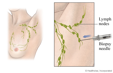 Fine-needle lymph node biopsy