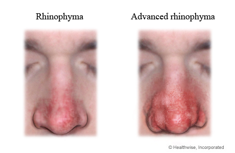 Photos of man with rhinophyma and advanced rhinophyma on the nose