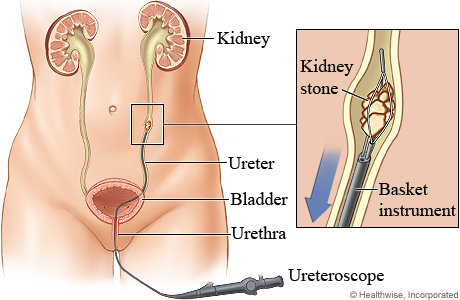 How a ureteroscope is used to remove a kidney stone