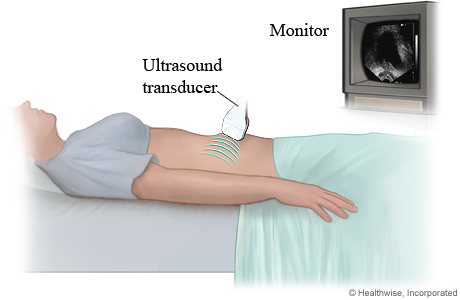 Woman having a transabdominal ultrasound