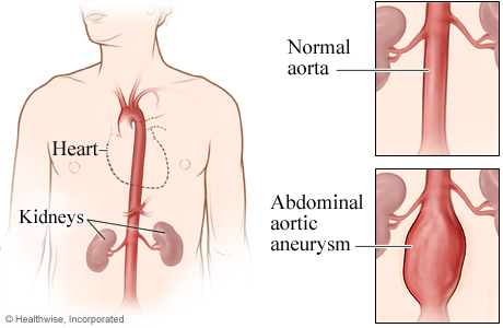 A normal aorta and an abdominal aortic aneurysm
