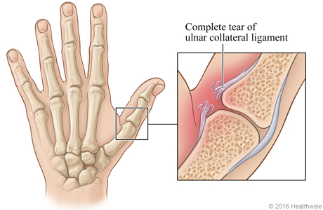 Skeletal view of hand, with detail of complete tear of ulnar collateral ligament in thumb