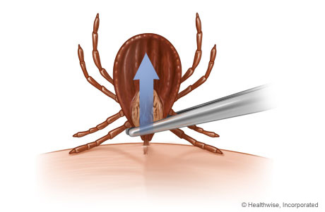 Removing a tick with tweezers.