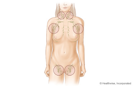swollen lymph nodes groin hiv