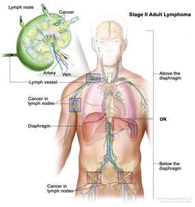 Stage II adult lymphoma; drawing shows cancer in two lymph node groups above the diaphragm and below the diaphragm. An inset shows a lymph node with a lymph vessel, an artery, and a vein. Cancer cells are shown in the lymph node.
