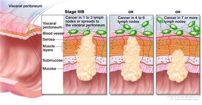 Stage IIIB colorectal cancer; drawing shows a cross-section of the colon/rectum and a three-panel inset. Each panel shows the layers of the colon/rectum wall: the mucosa, submucosa, muscle layers, and serosa. Also shown are a blood vessel and lymph nodes. The first panel shows cancer in all layers, in 3 nearby lymph nodes, and in the visceral peritoneum. The second panel shows cancer in all layers and in 5 nearby lymph nodes. The third panel shows cancer in the mucosa, submucosa, and muscle layers and in 7 nearby lymph nodes.