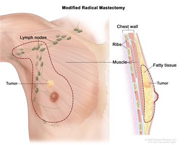 Modified radical mastectomy; the drawing on the left shows the removal of the whole breast, including the lymph nodes under the arm. The drawing on the right shows a cross-section of the breast, including the fatty tissue and chest wall (ribs and muscle). A tumor is also shown in the breast.