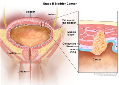Stage II bladder cancer (muscle-invasive bladder cancer); drawing shows the bladder, ureter, prostate, and urethra. An inset shows cancer in the inner lining of the bladder and in the layer of connective tissue and the muscle layers of the bladder. Also shown is the layer of fat around the bladder.