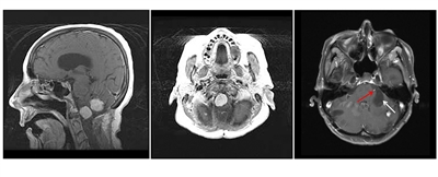Three-panel image showing a sagittal view of two prominent light-colored brainstem and cerebellar lesions (left panel), an axial view of a prominent brainstem lesion (middle panel), and an axial view of a cerebellar lesion with a large, dark area that is a cystic component (right panel).