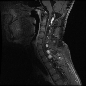 Sagittal view of an individual's neck showing several light-colored lesions along the spinal cord.