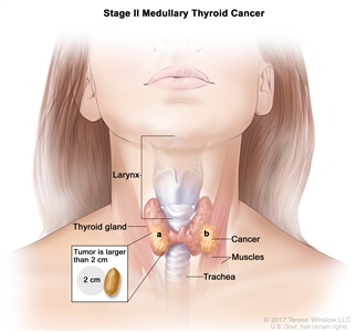 Stage II medullary thyroid cancer; drawing shows (a) cancer in the thyroid gland and the tumor is larger than 2 centimeters and (b) cancer has spread to nearby muscles in the neck. An inset shows 2 centimeters is about the size of a peanut. Also shown are the larynx and trachea.
