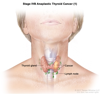 Stage IVB anaplastic thyroid cancer (1); drawing shows cancer in the thyroid gland and nearby lymph nodes.